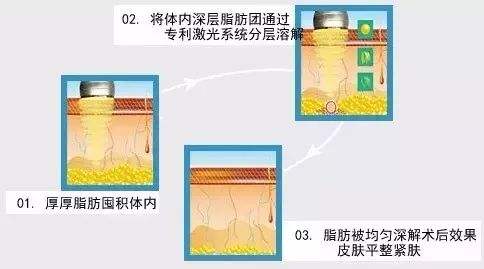 光纤微创溶脂大概多少钱?听说贵得有点离谱?