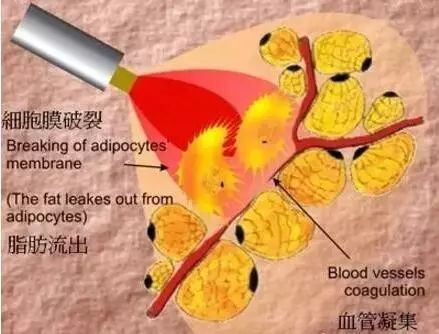 光纤微创溶脂大概多少钱?听说贵得有点离谱?