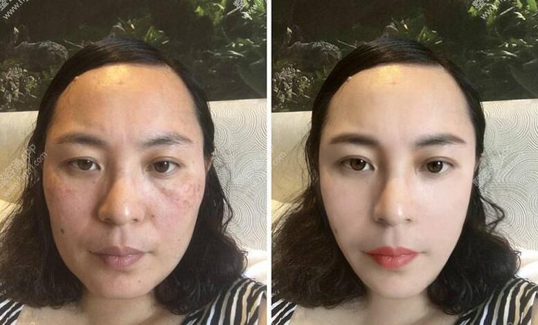 果酸换肤