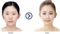 宽下颌角整形手术有风险吗 width=