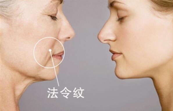 去鼻唇沟多少钱？会不会很贵？