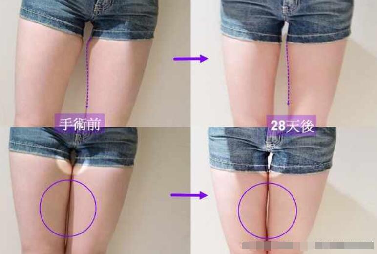 上海镭射溶脂价格要多少?