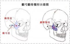下颌角接骨整形技术有多厉害？看到第3个我都心动了…  width=