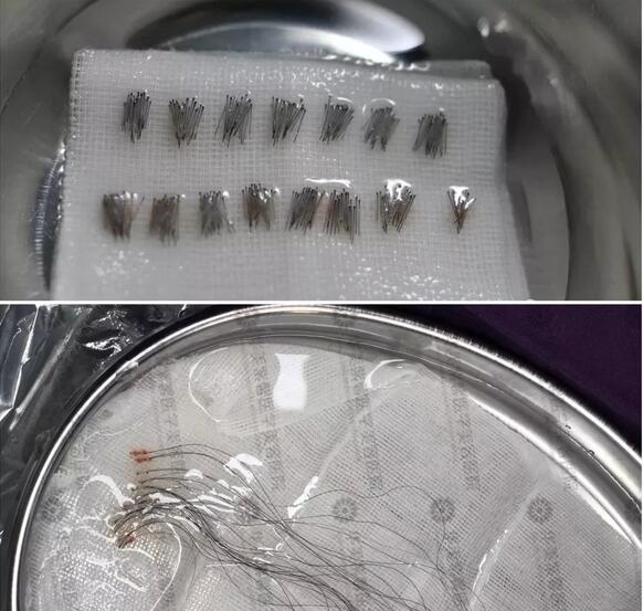 人工植发多少钱|华美紫馨刁永锋医生来解答~