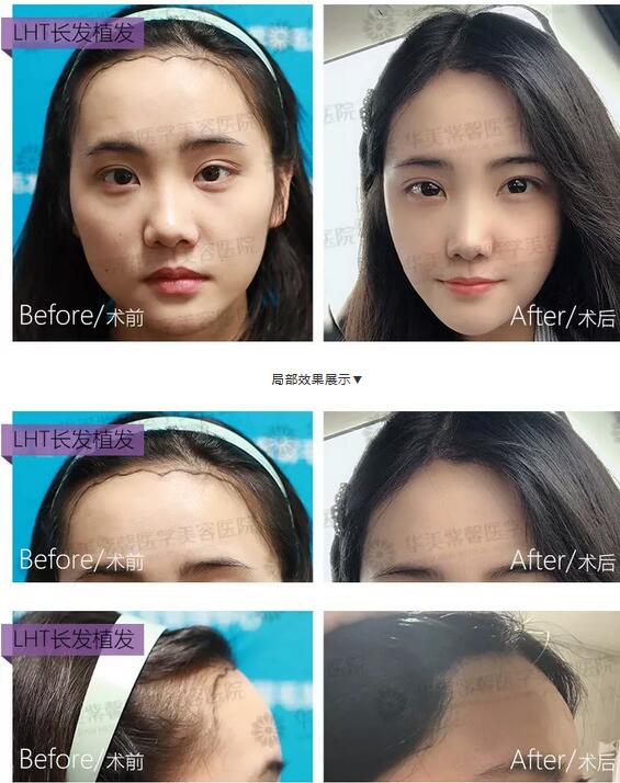 人工植发多少钱|华美紫馨刁永锋医生来解答~
