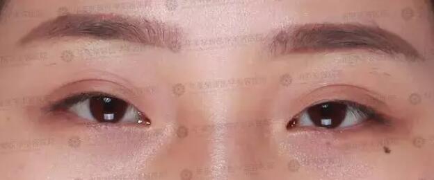 上睑下垂怎么矫正好？华美紫馨急速纳米美眼技术灰常妙！