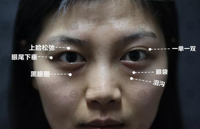 上睑下垂怎么矫正好？华美紫馨急速纳米美眼技术灰常妙！