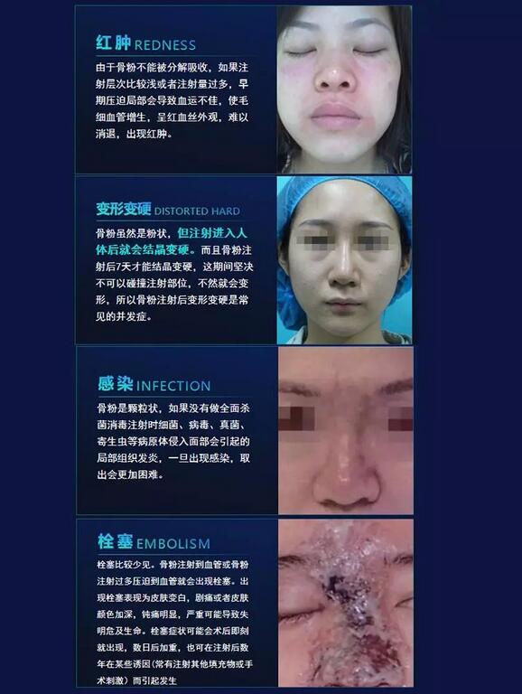 人工骨粉注射隆鼻