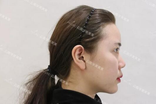 塌鼻子隆鼻前后对比