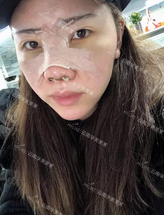 塌鼻子隆鼻前后对比