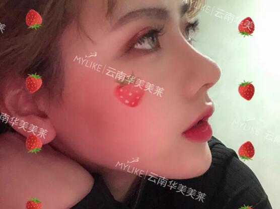 塌鼻子隆鼻前后对比