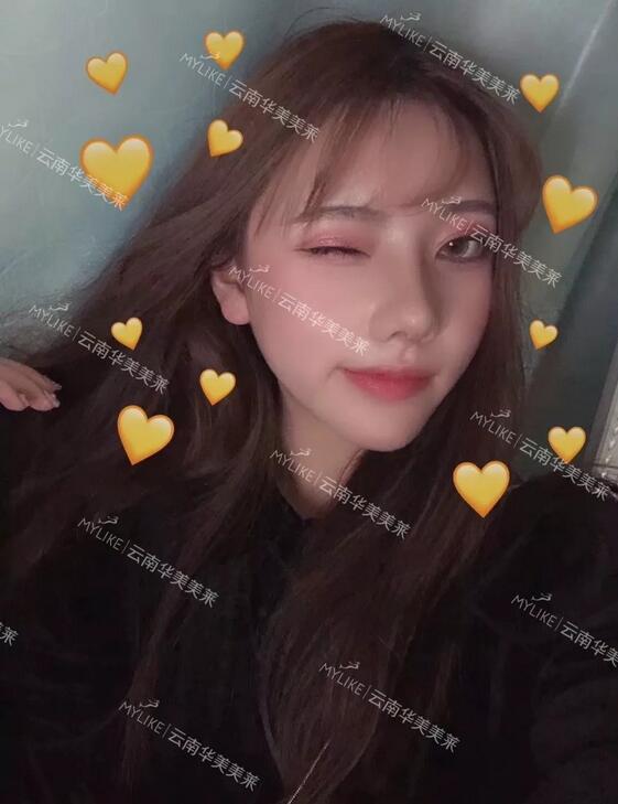 塌鼻子隆鼻前后对比