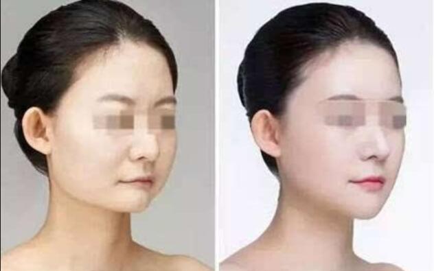 伊维兰丰下巴