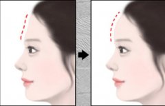 隆额头维持多久?隆额头果长久吗? width=