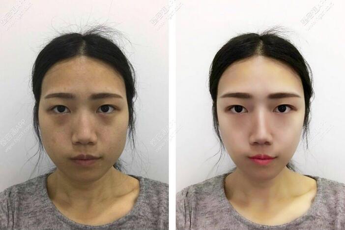 北京打美白要花多少钱?贵不贵喃?