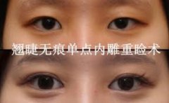 韩式翘睫双眼皮有哪些优势？给我列出来！ width=