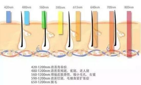 强脉冲光脱毛有啥优势?听俺细细道来~