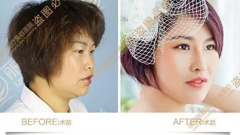 贵阳丽都整形： 这几类眼睛在做双眼皮前一定要谨慎！！！