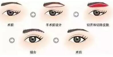 贵阳丽都整形： 这几类眼睛在做双眼皮前一定要谨慎！！！