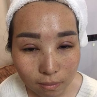 成都华博整形医院c6激光祛斑果如何?真实案例曝光