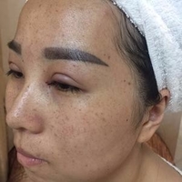 成都华博整形医院c6激光祛斑果如何?真实案例曝光