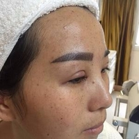 成都华博整形医院c6激光祛斑果如何?真实案例曝光