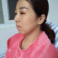 成都华博整形医院c6激光祛斑果如何?真实案例曝光