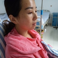 成都华博整形医院c6激光祛斑果如何?真实案例曝光