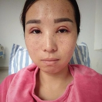 成都华博整形医院c6激光祛斑果如何?真实案例曝光
