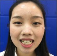 【合众齿科半隐形陶瓷矫正1天到365天的对比】终于可以笑出较美八颗牙 width=