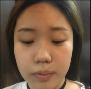 杨幂朝天鼻孔照有多难看，真人体验朝天鼻矫正案例一览 width=