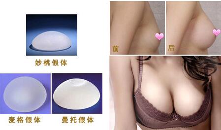 水滴型假体隆胸多少钱?多少合理~