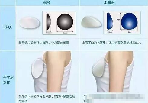 水滴型假体隆胸多少钱?多少合理~