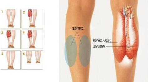 注射瘦脸注射瘦腿多少钱?编哥给你分析~