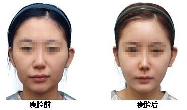 光纤溶脂多少钱一个部位呢?听说老贵了!