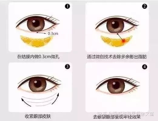 美诗沁光乳化去眼袋后，刘姐生活更加灿烂~