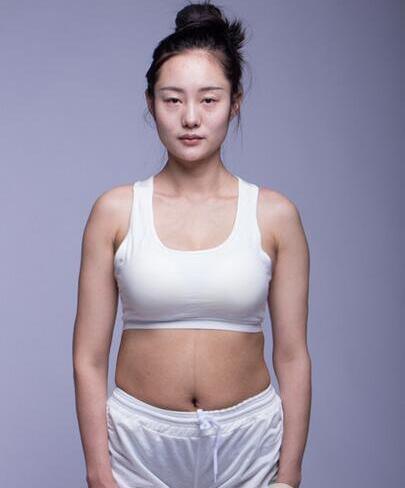 广州星团医学整形美容水动力吸脂日记，内附价格表~