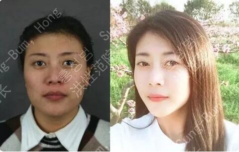 颧骨整形失败案例有吗？洪性范：你没听说过我吗？！