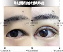 韩式翘睫双眼皮好不好? width=