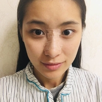 巫文云隆鼻果如何?真像广告上说的那样好?