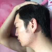 无锡DBC李艺恩院长皮肤美容技术如何?请看案例分析