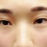 沈阳百嘉丽侯亚杰眼部手术真实案例分享~~