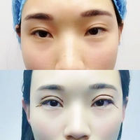 沈阳百嘉丽侯亚杰眼部手术真实案例分享~~
