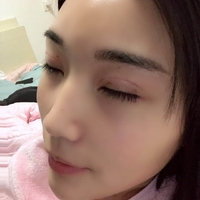 沈阳百嘉丽侯亚杰眼部手术真实案例分享~~