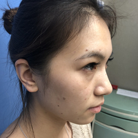 李芳整形果如何?双眼真实案例为你诠释