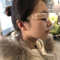 李芳整形果如何?双眼真实案例为你诠释