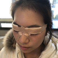 李芳整形果如何?双眼真实案例为你诠释
