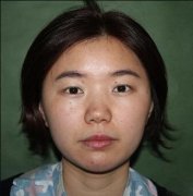 伊美尔吸雕双眼皮手术案例对照图—用心记录的90天恢复小札 width=