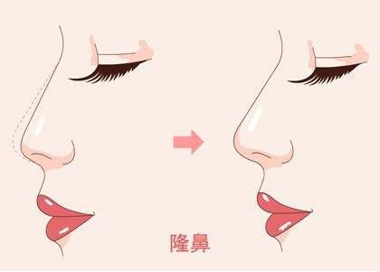 王艇隆鼻好还是王军隆鼻好，给点意见吧~