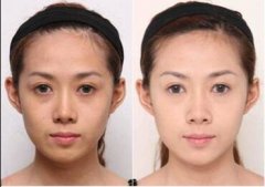 隆额头维持多久?果长久吗? width=